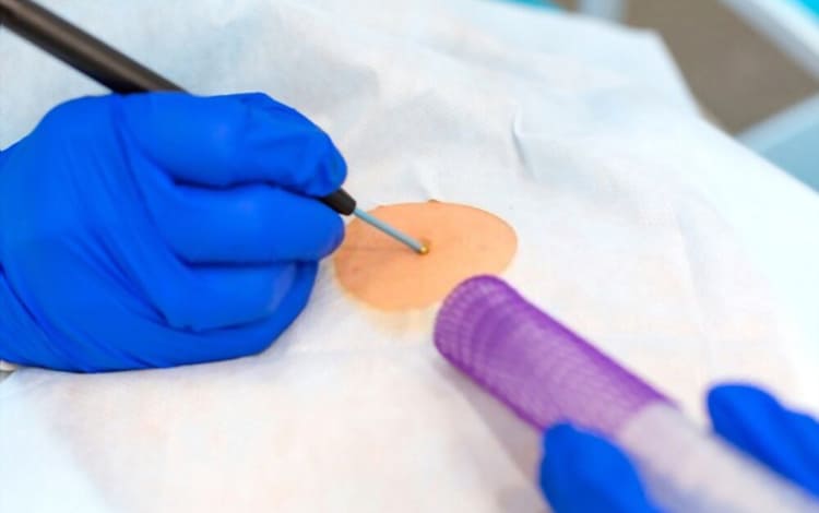 Biopsia de lesiones  piel