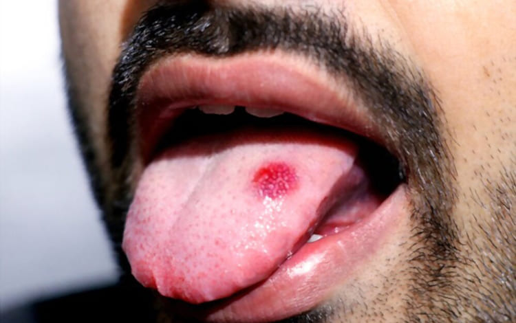 Glosectomias parciales o Hemiglosectomias